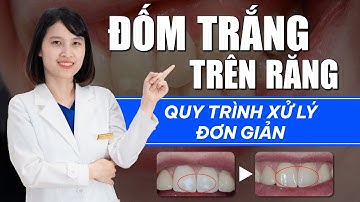 Đốm Trắng Trên Răng - Quy Trình Xử Lý Đơn Giản Tại Nha Khoa Vinalign | Nam Bùi Vinalign