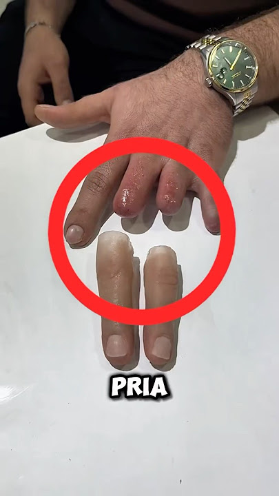 Pria Ini Digigit Ular Langka yang Tak Ada Obatnya‼️😱