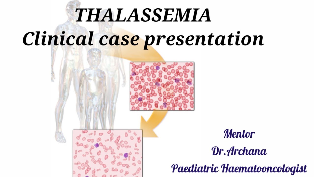 case study of thalassemia major