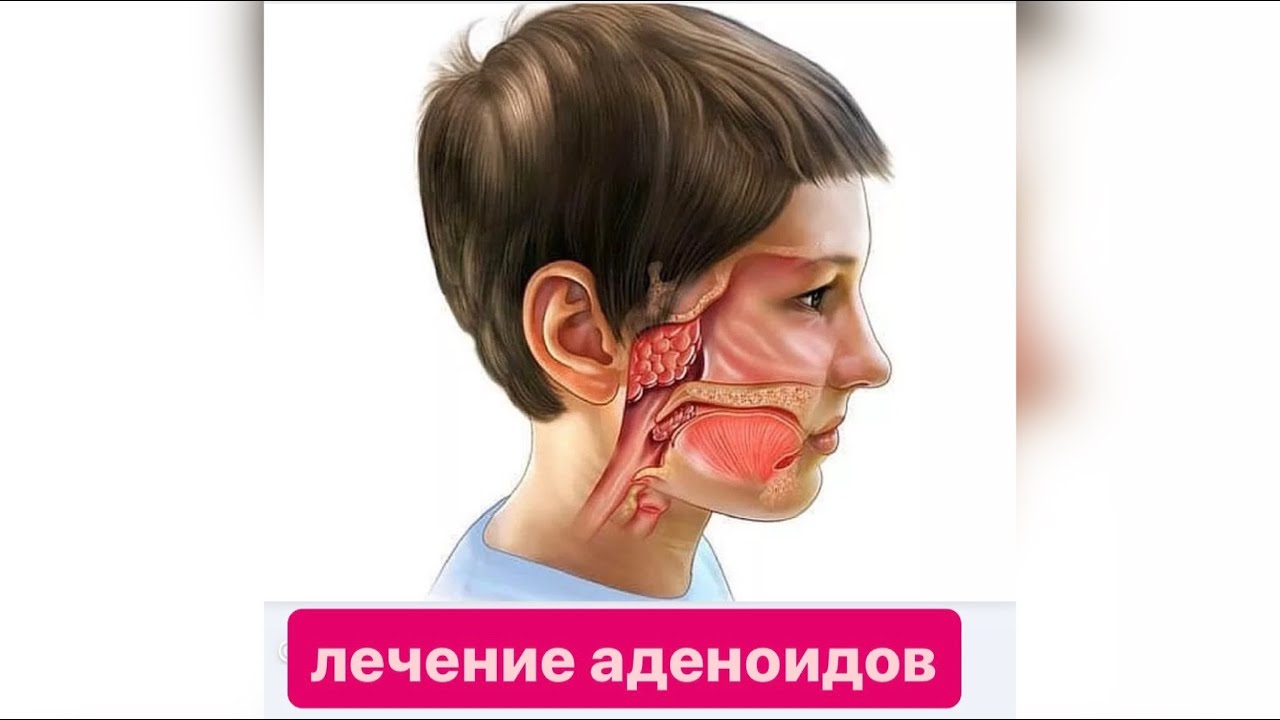 Аденоиды лечение в Кемерово: цена — лор лечение аденоидов без операции у врача
