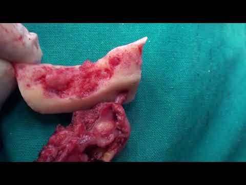 Video: Rak Usta (Gingiva Fibrosarcoma) Kod Pasa