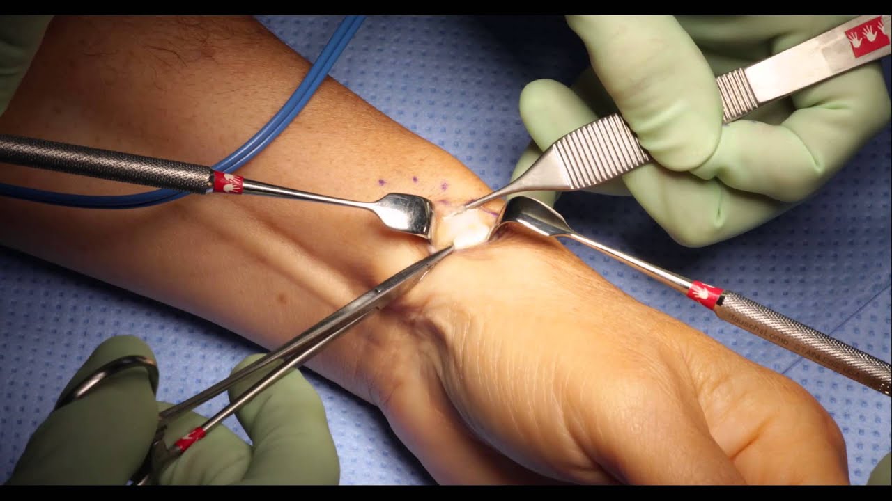Flexor tendolysis a kézen