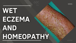 wet eczema and homeopathic treatment || best homeopathic medicine for wet eczema 