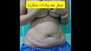 بعد شهور من شد ونحت البطن والخصر #tummytuck