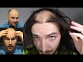 Balding Influencer Courageously Shaves Off His Previously Transplanted Hair - *Baldcafe Reacts*