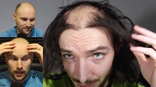 Balding Influencer Courageously Shaves Off His Previously Transplanted Hair - *Baldcafe Reacts*