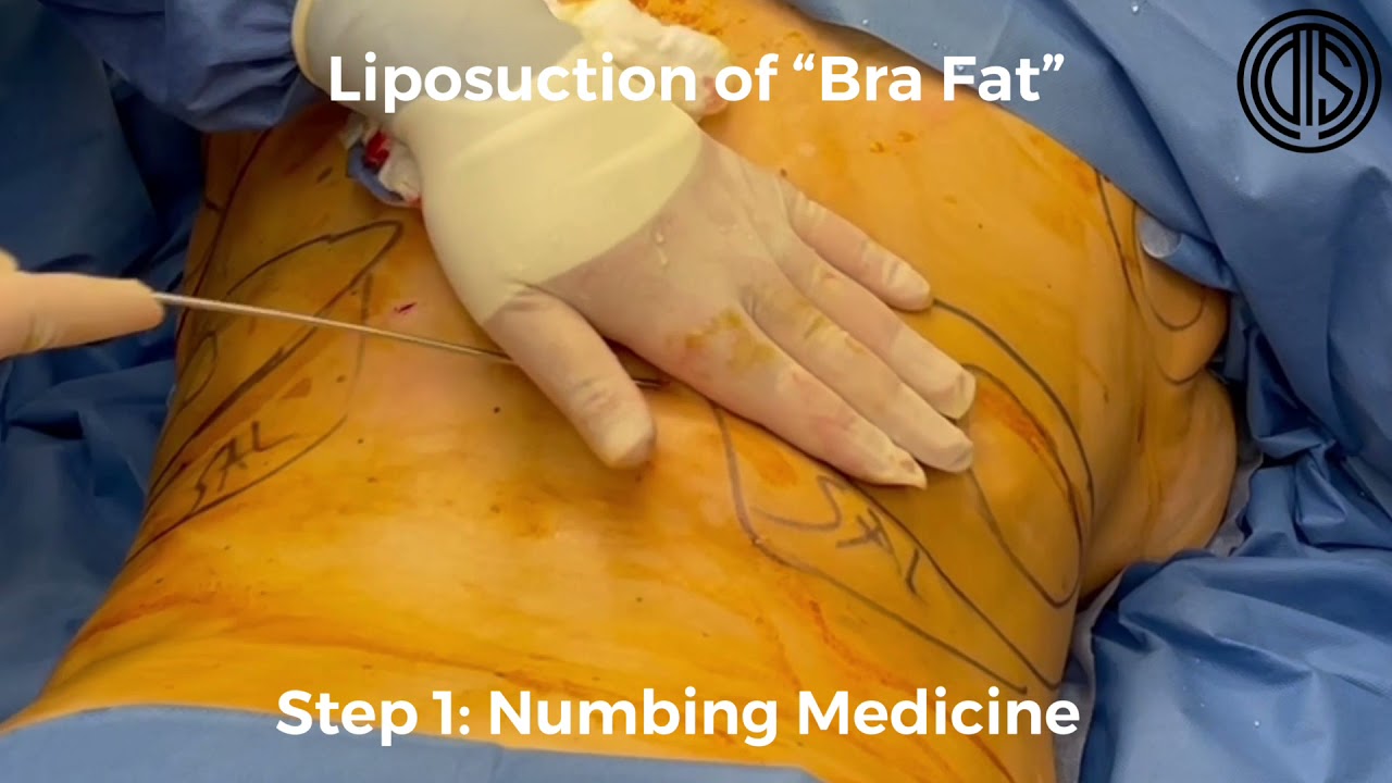 Liposuction of Bra Fat 