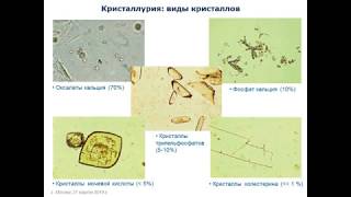 Кристаллурия в диагностике заболеваний почек