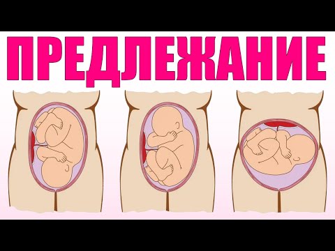 Видео: Какое нормальное положение плода?