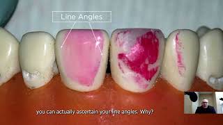 Using Articulating Paper to Determine Needed Texture on Your Composite Restoration