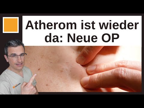 Video: Atherom Am Rücken - Symptome Und Behandlung