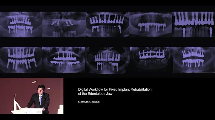 Digital Workflow for Fixed Implant Rehabilitation ...