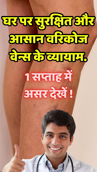 Best Exercises for Varicose Veins #shortsfeed #viral #doctor #vericoseveins #gulabisadi #facts