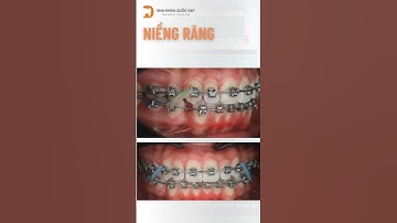 Đóng khoảng nhổ răng khi niềng răng #niengrang #brace #nkqd #nhakhoaquocdat