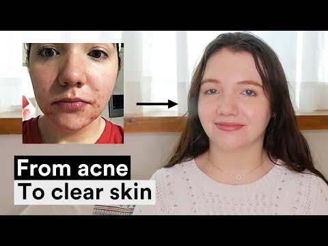 Sidney&#;s Acne Recovery l The Best Natural Cleanser for Oily & Acne prone skin