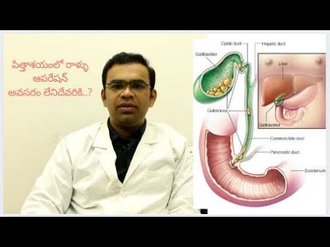 పిత్తాశయంలో రాళ్ళు.. ఆపరేషన్‌ అవసరమా..? Gallbladder Stones Symptoms | How To Cure Gallbladder