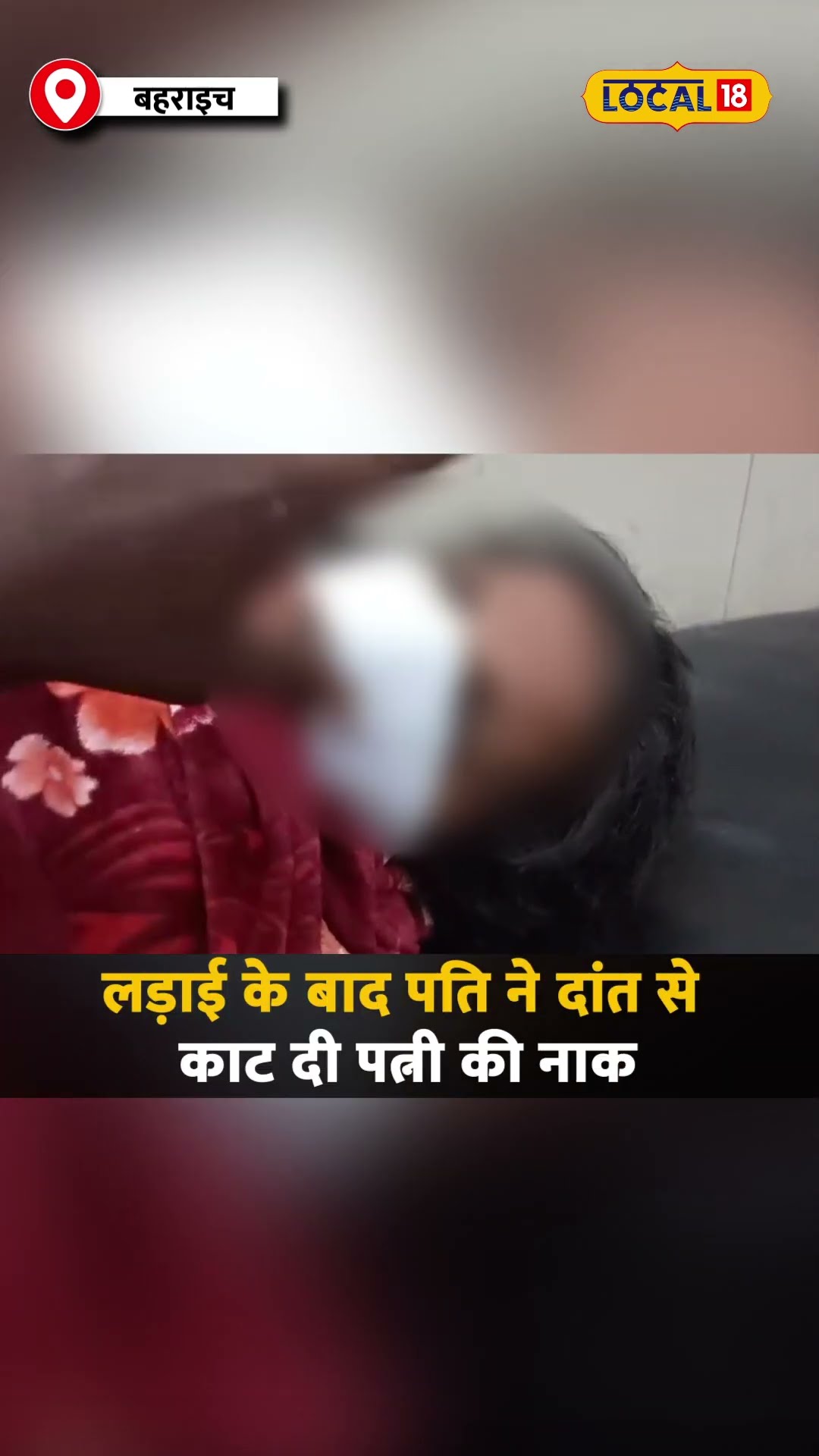 Husband Chewed Wife Nose: लड़ाई के बाद पति ने दांत से काट दी पत्नी की नाक #local18shorts