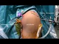Arthroscopy Shoulder Surface Landmarks | Arthroscopic Supraspinatus Tear - Shoulder Sports Injury 