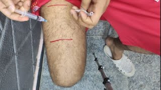 طريقة اعطاء الابر في عضلة الفخذ thigh muscle injection