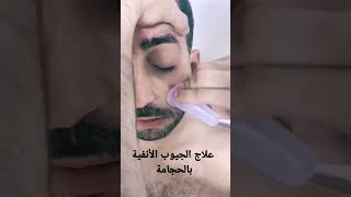 علاج الجيوب الأنفية (الحجامة التجميلية)