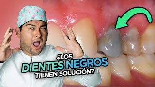 Tienes Un Diente Por Endodoncia? Por Que Pasa Y Como Blanquearlo ?