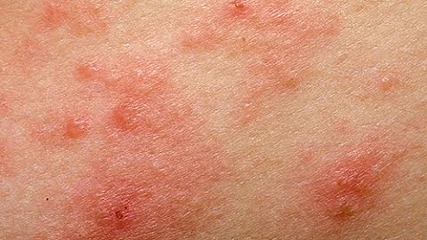 Comment on attrape de l'eczéma ?