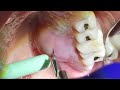 Gum Abscess!  All About Dental Abscesses, Tooth Abscesses and Drainage