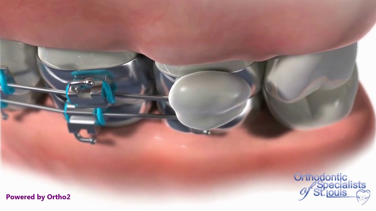 Wax Placement Orthodontic Care Instructions YouTube