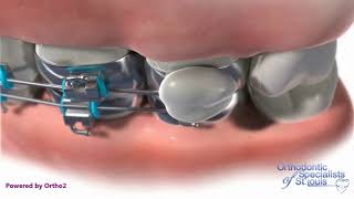 Wax Placement - Orthodontic Care Instructions screenshot 4