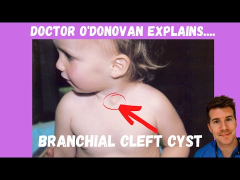 Explaining Branchial Cleft Cyst | With Dr O&rsquo;Donovan