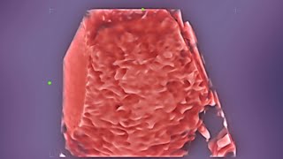 Placentomegaly With Aedf Fetal Doppler Ultrasound