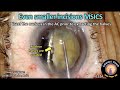 Cataractcoach 1324 even smaller incision msics cataract surgery
