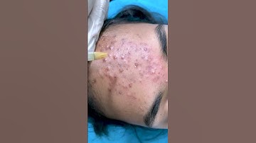 Thumbnail of chemical peel treatment for acne | acne treatment  | Skinaa Clinic #viral #shorts