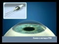 PRK - метод за лазерна корекция на зрението