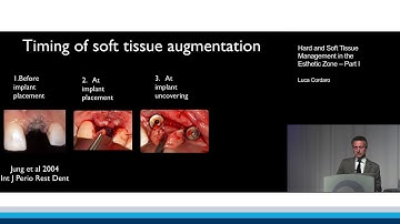 Hard and Soft Tissue Management in the Esthetic Zone – Part I | Luca Cordaro