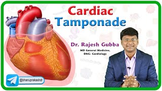 Cardiac Tamponade : Etiology, Pathophysiology, Clinical features, Diagnosis and Treatment