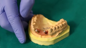 Dynamic Abutment Solutions