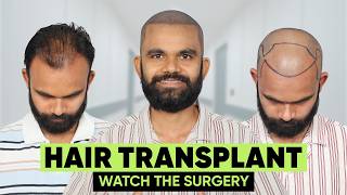 Hair Transplant in Purnia (HX-VGCA) | Best Results & Cost of Hair Transplant in Purnia