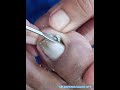 part2 super narrow nail saving |MR.INGROWN DAVAO CITY