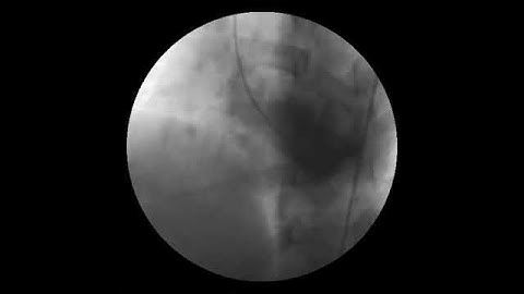 Ventricular Septal Defect seen on LV gram