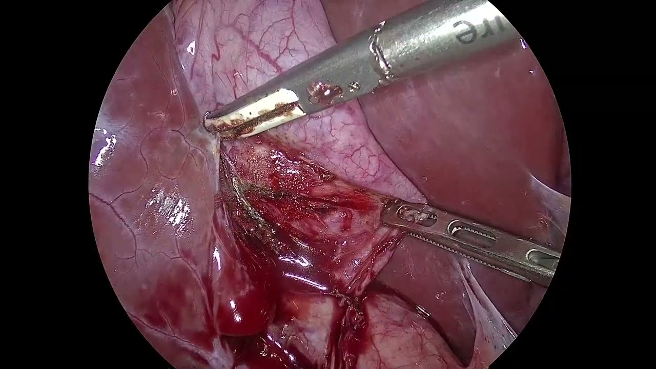 Lap Choledochal Cyst excision with Roux-en-Y Hepaticojejunostomy