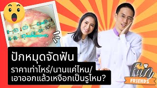 หมุดจัดฟันราคาเท่าไหร่ ต้องปักนานแค่ไหน เอาออกแล้วเหงือกเป็นรูหรือไม่? |FunFriends เพื่อนกันฟันดี|