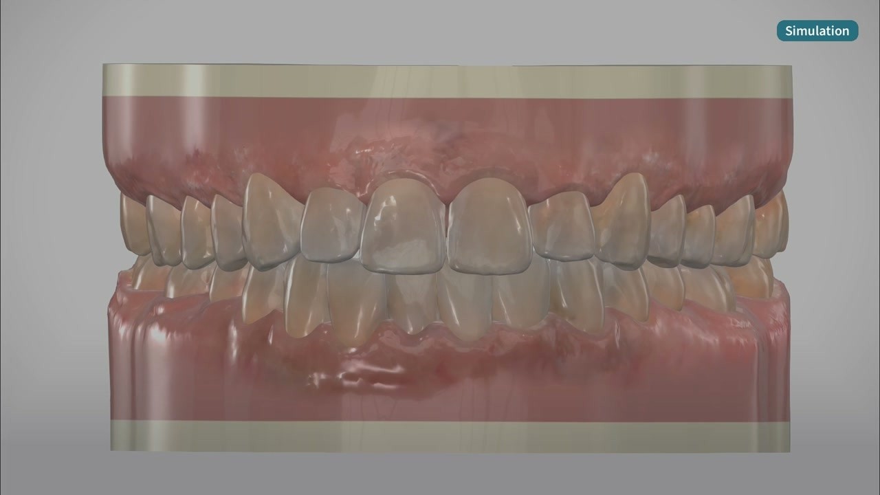 How Invisalign Moves Crowded Teeth (3D Simulation) - YouTube