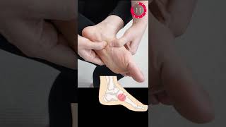 Foot Arch Massage to Correct Bunions