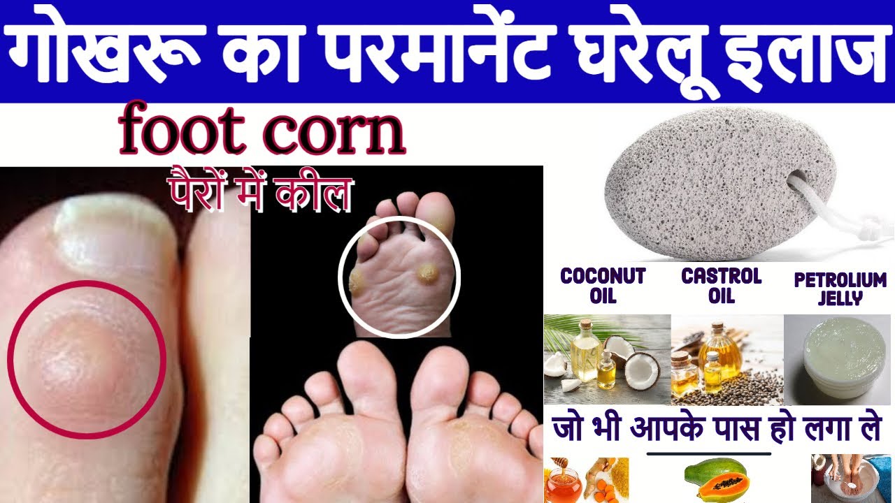पैर के तलवे में गोखरू का इलाज How to remove corn at home foot corn