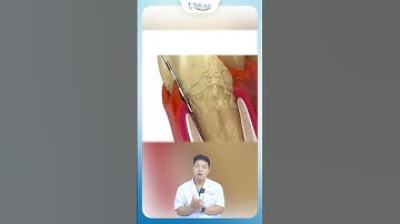 Lý Do Răng Rụng Khi Bạn Vẫn Còn Trẻ | Nha Khoa Minh Châu