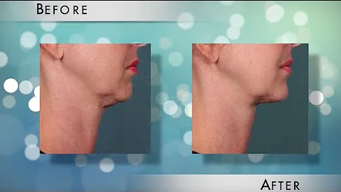 Kybella Procedure