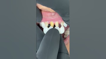 Trying in a Temporary Bridge