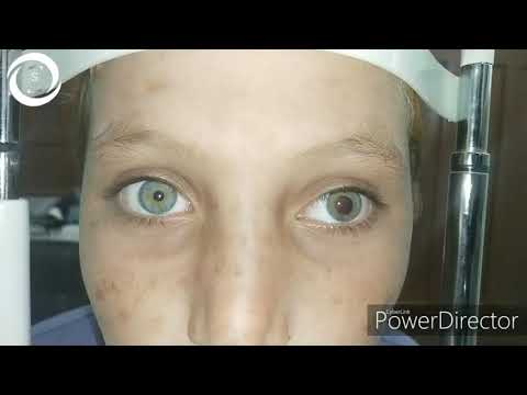 Video: På Grund Af En Sjælden Genetisk Funktionsfejl Har Pigen Skræmmende Store Pupiller I øjnene - Alternativ Visning