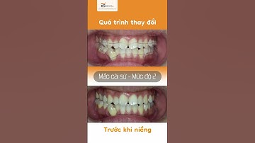 Thanh Toàn - Kiến tạo nụ cười với niềng răng mắc cài sứ